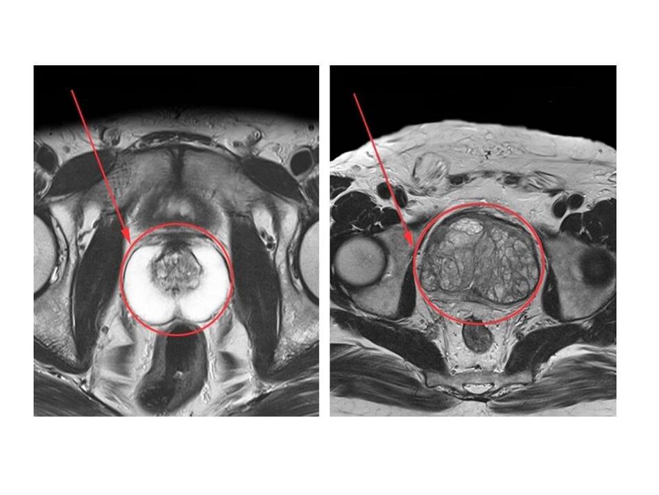 Comparaison d'une prostate saine (à gauche) et d'une prostate enflammée (à droite) sur des images IRM
